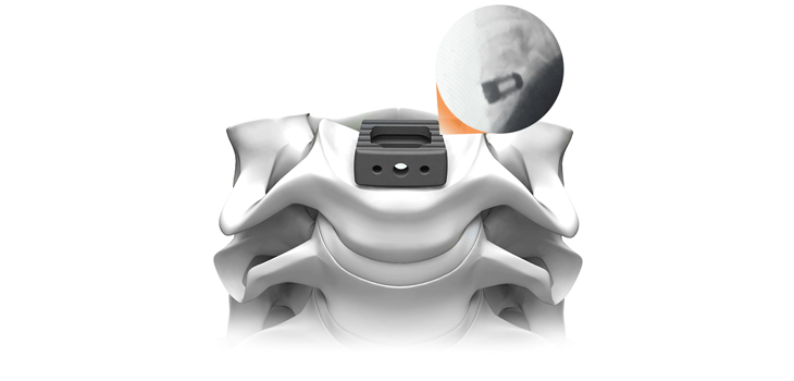 Cervical Spacer System Cleared for Life Spine