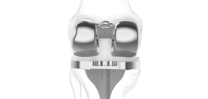 Customized Knee Implant Study: Above Average ROM