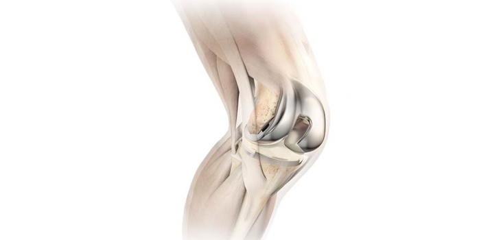 Unusual Way to Introduce a Knee Implant