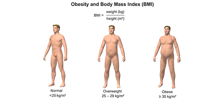 Obese Patients Denied Joint Replacement Surgery