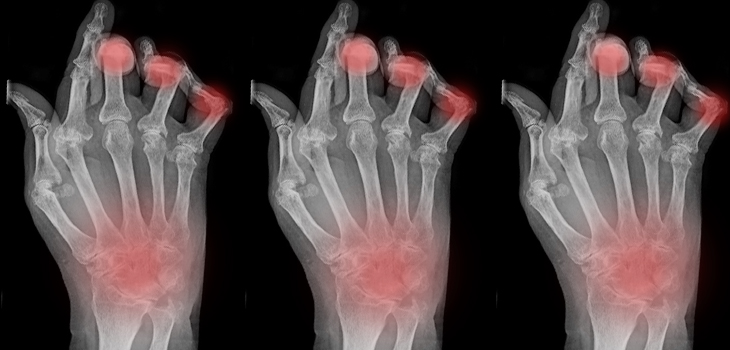 RA: New Options for Prognosis, Therapy