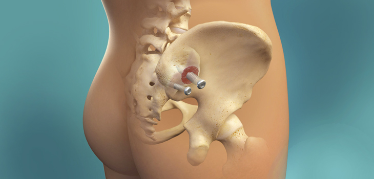 New Zyga Study: Positive 24-Month SI Fusion Outcomes