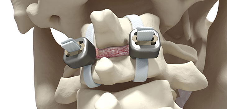 Implanet’s “Strapping” Stabilization System Cleared in Europe
