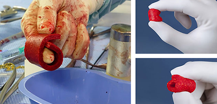 1st in Large Joints for CERASORB Ortho Foam
