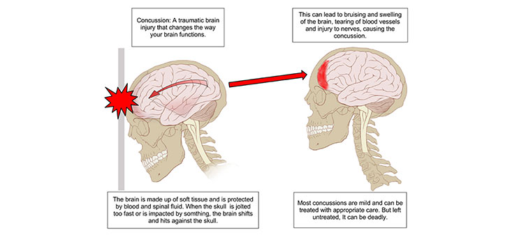 Updated Guidelines Redefine “Rest” After Concussion