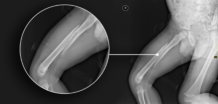 New Study: Teriparatide Fails at Fracture Healing