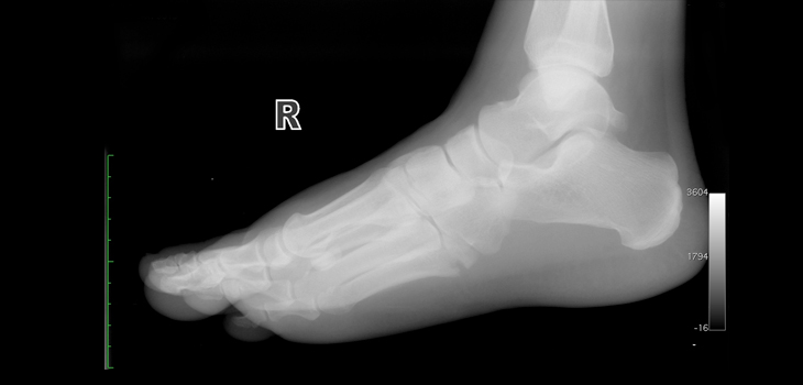 New Technique for Jones Fracture Fixation Improves Stability