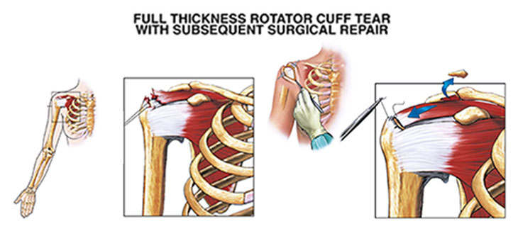 Linked Single-Row Rotator Cuff Repair Shows Promise