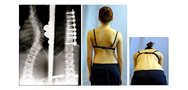 New Study Tackles Spine Deformity Hospital Acquired Condition