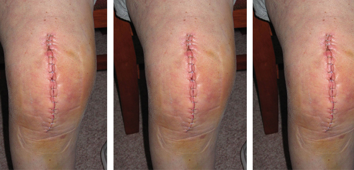 358 Limbs, 202 Patients, Valgus Cut Angle Resolved!?