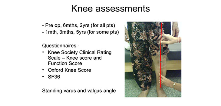 TKA: Standing Alignment Doesn’t Predict Dynamic Alignment