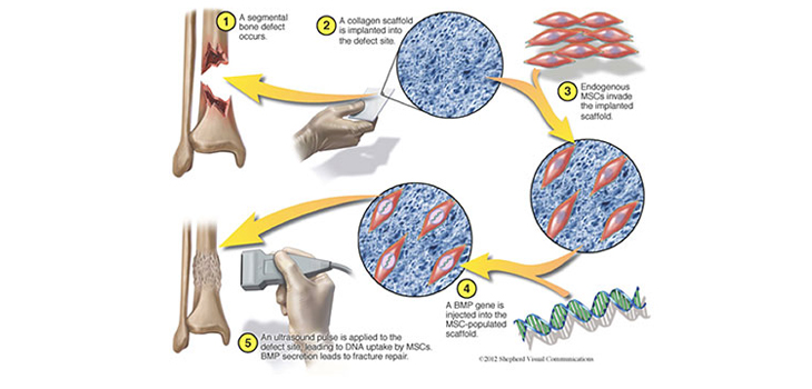 Bubbles and Gene Therapy Heal Major Bone Fractures in Pigs