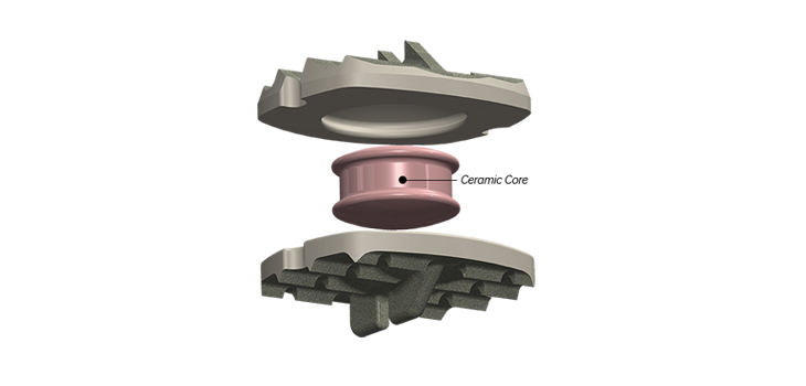 Simplify Cervical Disc: First U.S. Patient, Two Adjacent Levels