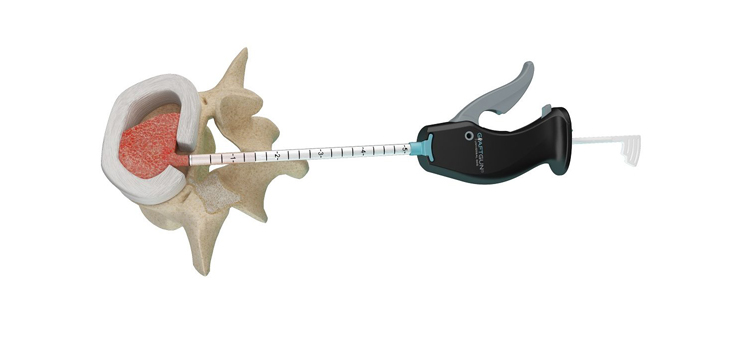 Patent Awarded for SurGenTec’s Graft Delivery System