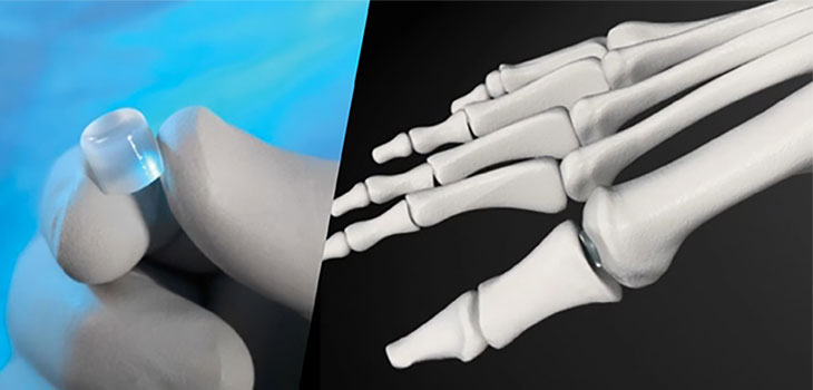 First 50 Patients Enrolled in Cartilage Study