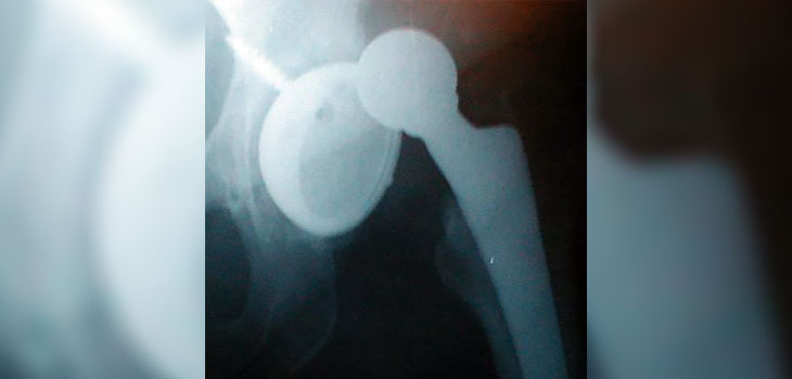 Lumbar Spinal Fusion Increases Hip Dislocation Risk