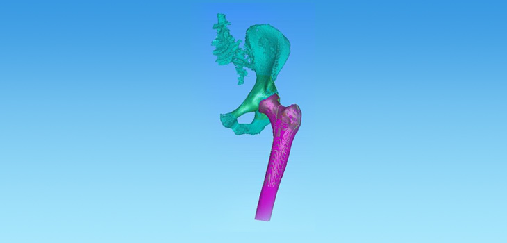 FDA Clears Customized Hip System