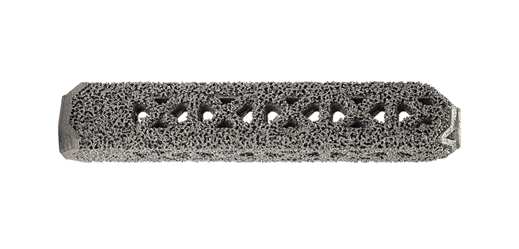 First 3D Implant for SI Joint Cleared by FDA