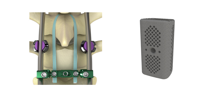 K2M Cage, Bands and Connectors Cleared by FDA