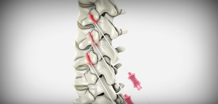 Facet Joint Pain Ablation Device Cleared by FDA