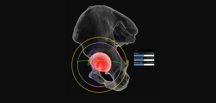 Australian Firm Makes Implants in the Cloud