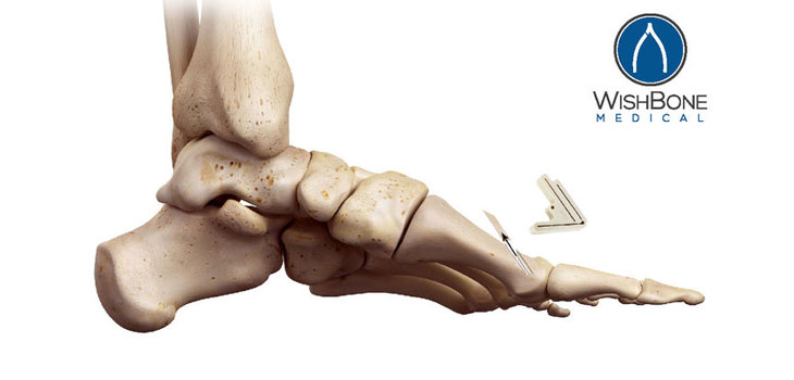 WishBone Medical Launches Exact Osteotomy System