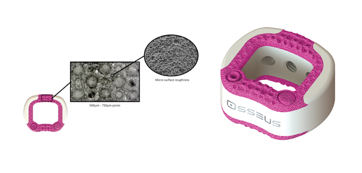 FDA Clears Osseus’ Cervical Implant