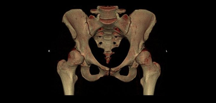 Hip Dysplasia and Arthroscopy…Approach With Caution