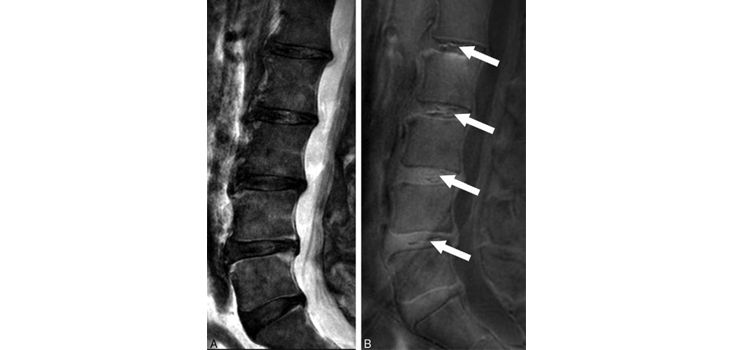 New Marker for Degenerative Disc Disease Disclosed