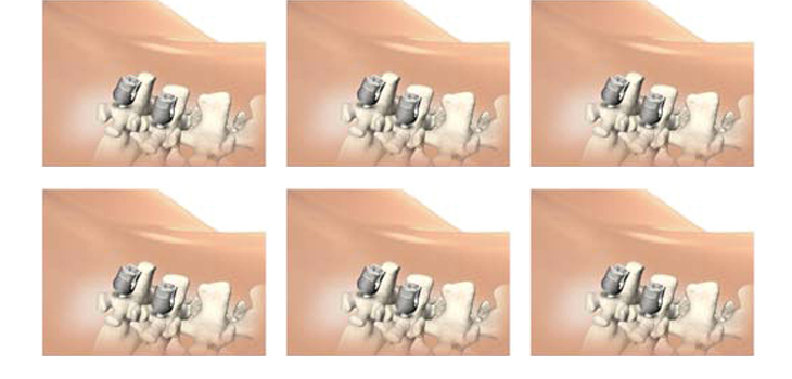 Stryker Pedicle Screw Cleared by FDA