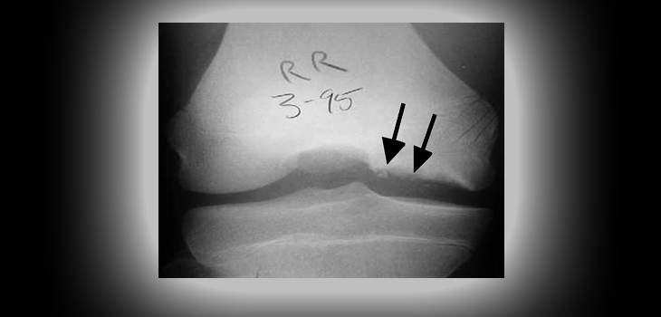 Mayo: Knee OCD on the Rise in Young Males?
