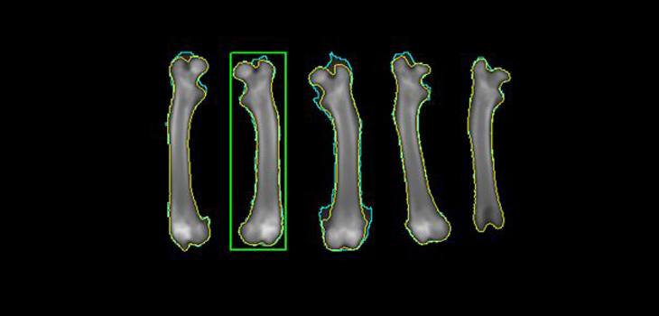 One BMD, History Assessment Predicts Hip Fracture Risk