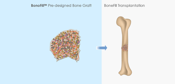 Liquid Bone Injected in World First Treatment