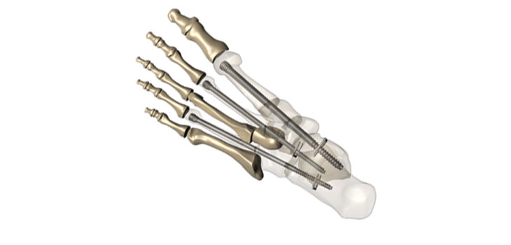 Novel Foot Fixation System Awarded 510(k) Clearance