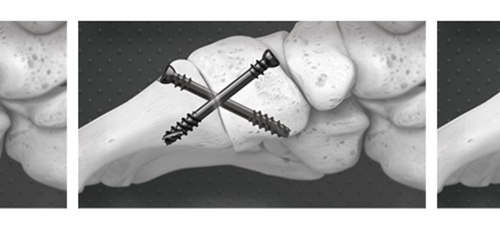 FDA Clearance for Foot Repair System