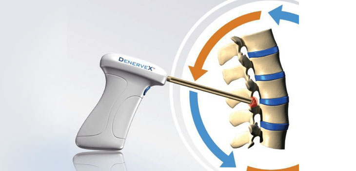 Shaving Process Treats Facet Joint Syndrome