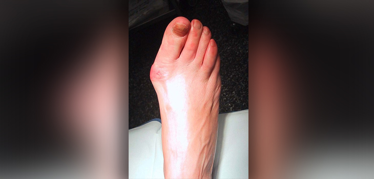 Mount Sinai Offers New Percutaneous Foot Surgery