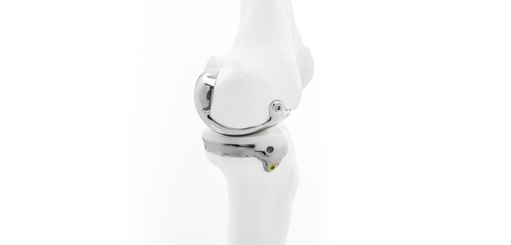 Bodycad: First Personalized Uni Knee Restoration