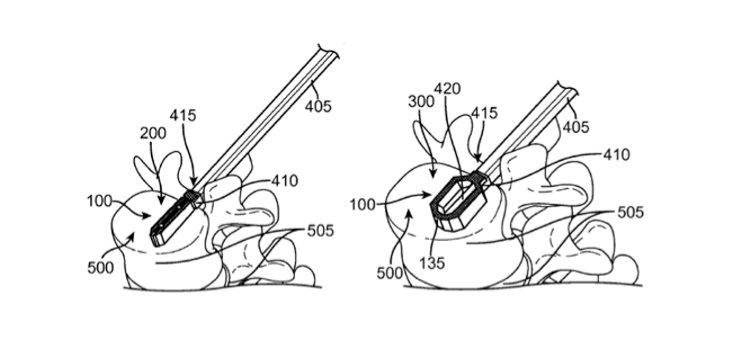 EIT Acquires Patent Portfolio for 3D Spinal Fusion Cages