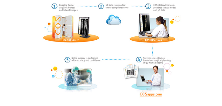 EOS Personalized Biomechanical Simulation Spine Surgery Planning