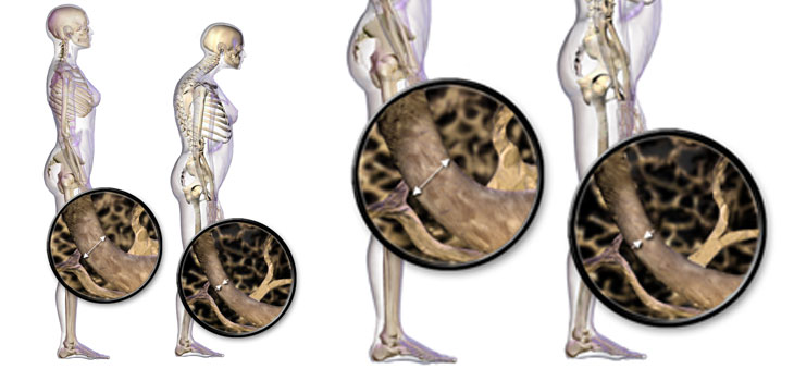 CT May Help With Site-Specific Osteoporosis