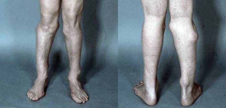 Promising Treatment for Rare Bone Disease HME