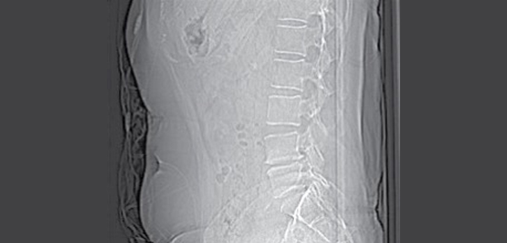 Spine Surgery Through the Belly Button!