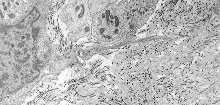 Combine Immunotherapy, Radiation…Fight Sarcoma