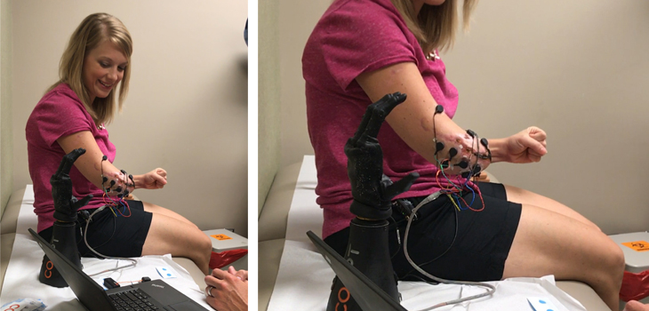 OrthoCarolina Docs Pioneer New Amputee Surgical Technique