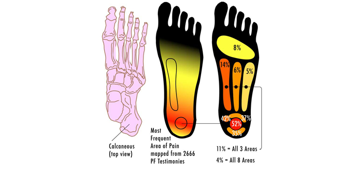 Mimedx’s AmnioFix Injection Reduces Plantar Fasciitis Pain