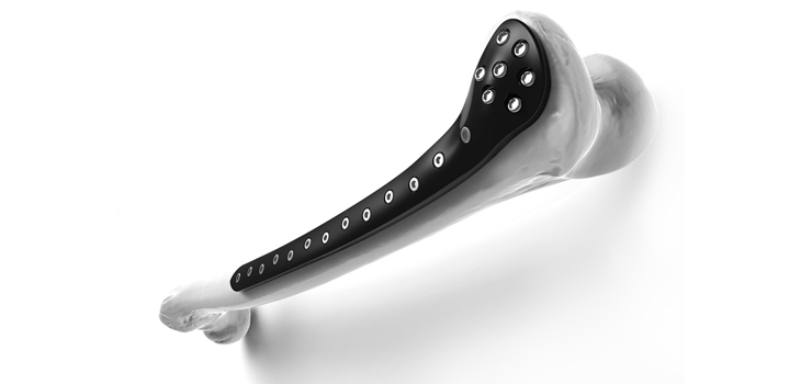 Carbon Reinforced PEEK for Trauma, Potentially Disruptive?