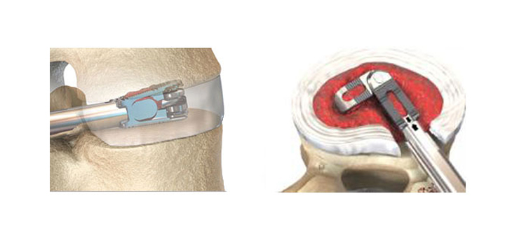 EOI: Two New U.S. Patents for Expanding Cage Technology