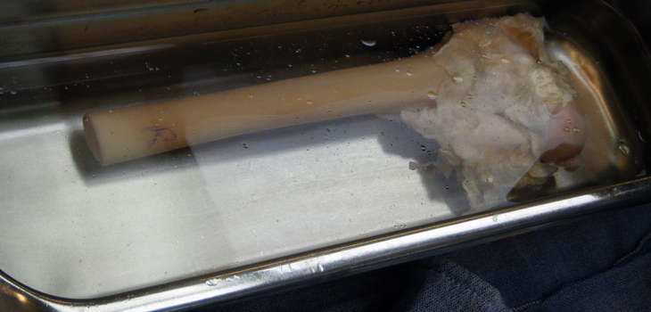 Allograft Joint Restoration vs Metal and Plastic