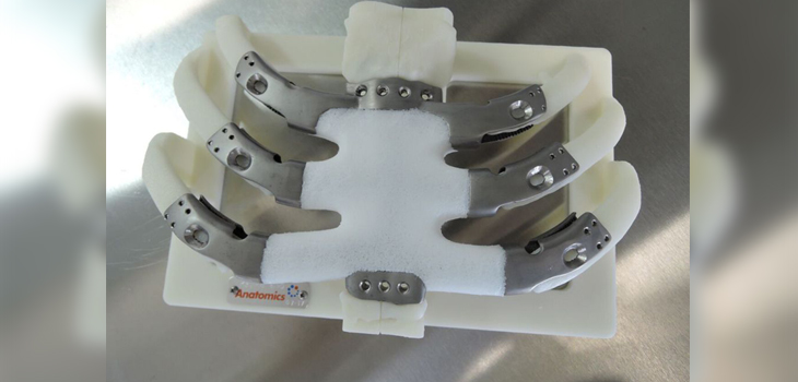 3D Printed Sternum/Ribcage Implanted in Surgical First